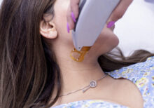 Laser Hair Removal Upper Lips