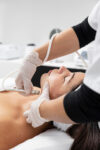 Laser Hair Removal Lip & Chin