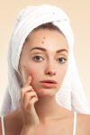 Anti Acne Facial