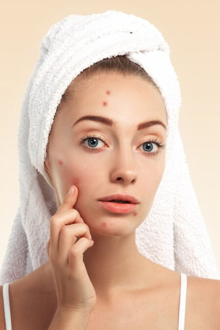Anti Acne Facial