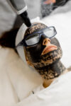Carbon Laser Peel Treatment
