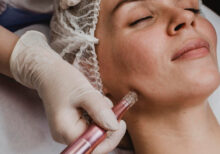 Micro Dermabrasion Treatment