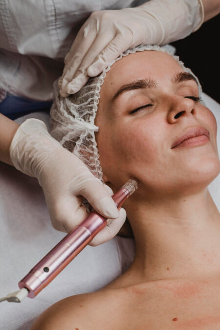 Micro Dermabrasion Treatment