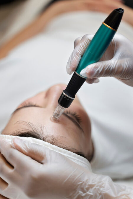 Microneedling Treatment