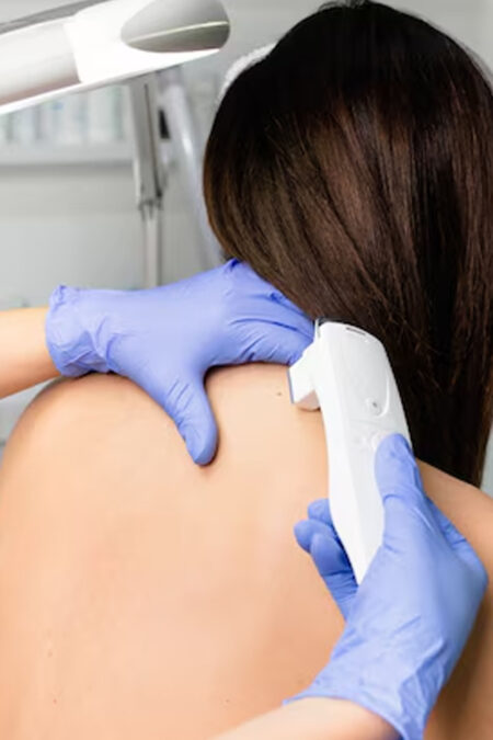 Laser Hair Removal Back