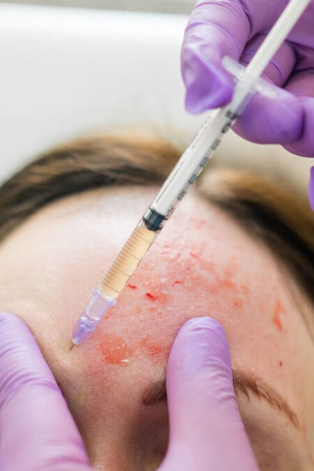 Vampire Facial Treatment