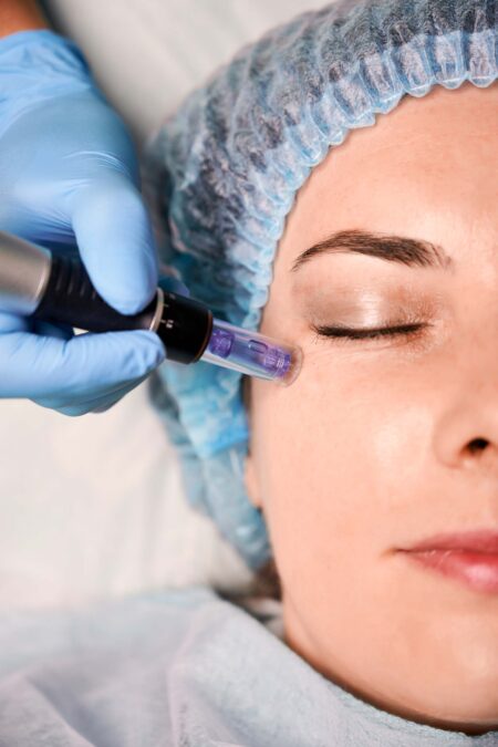 Plasma Pen Treatment